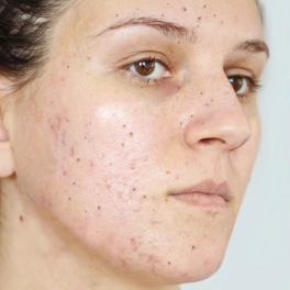 Moderate combination skin