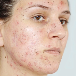Severe combination skin