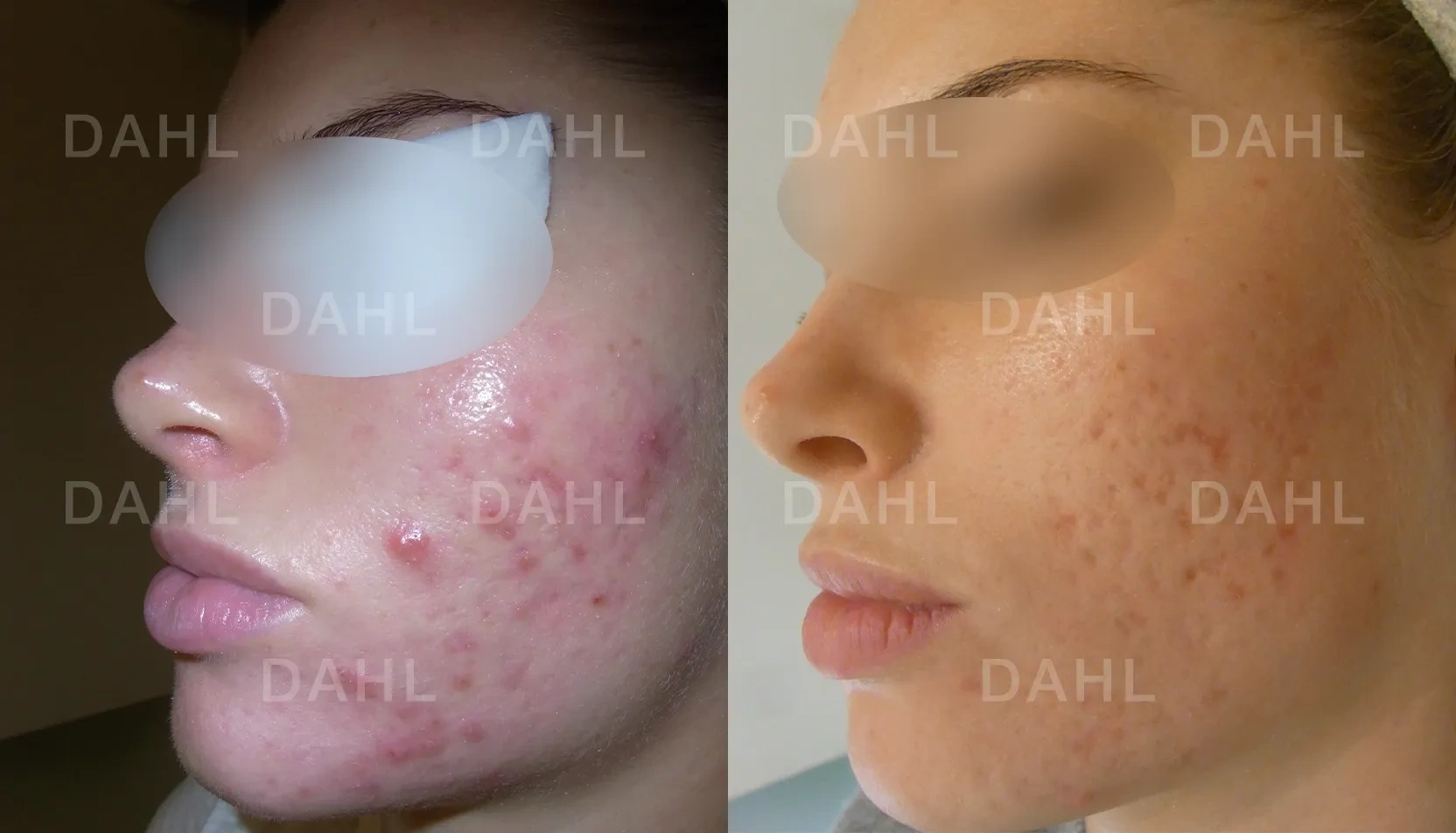 Before and after image of active acne