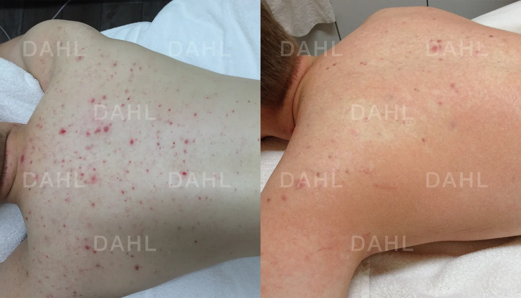 Back acne before and after treatment - DAHL Skincare