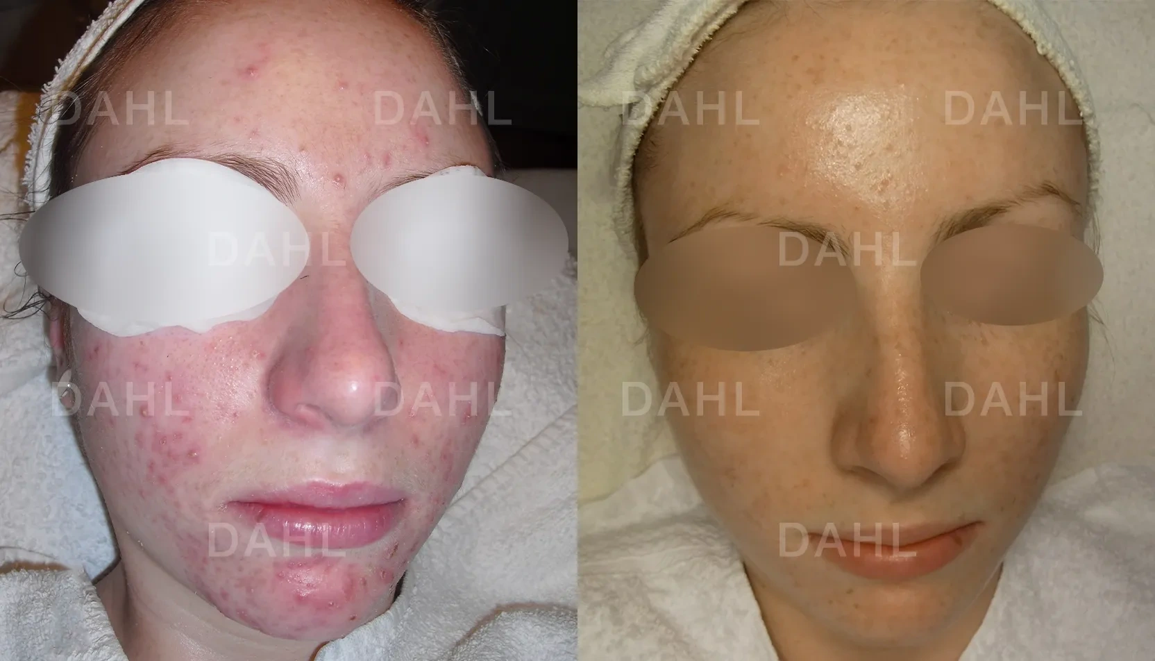 Acne on cheeks and chin - before and after