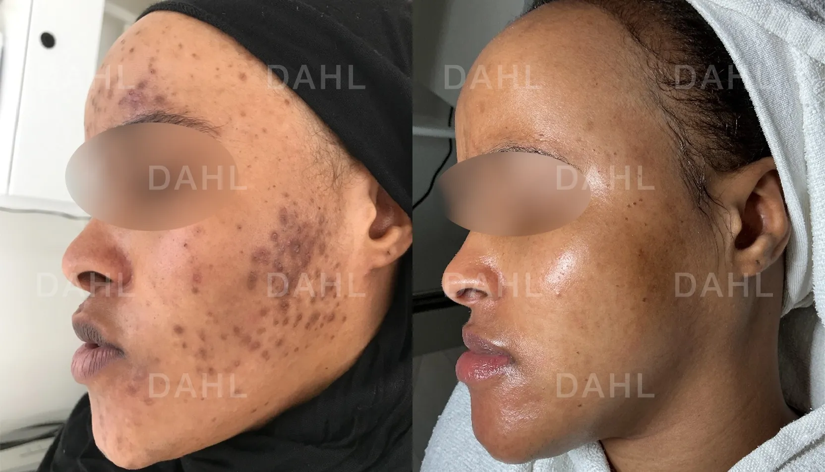 Treatment results for acne on cheeks and forehead - DAHL Skincare