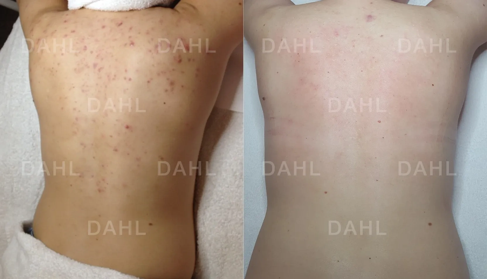 Before and after image of acne on full back