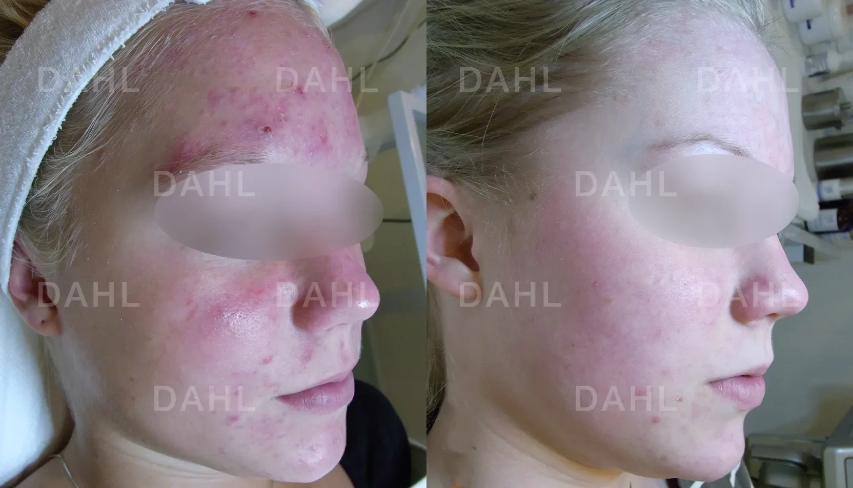Inflamed acne before and after - DAHL Skincare