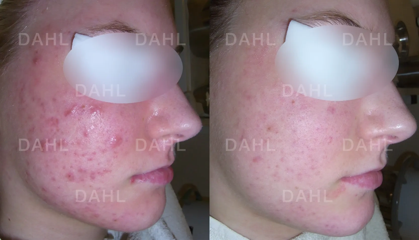 Before and after image of large pimples