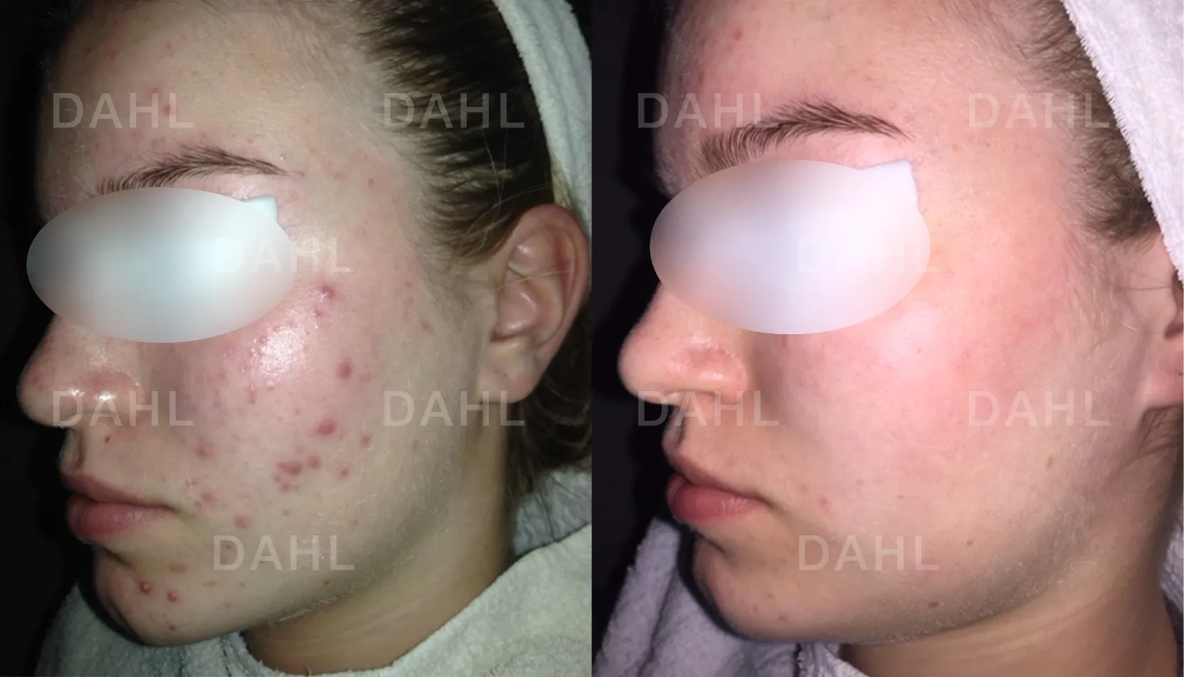 Before and after mild acne - DAHL Skincare