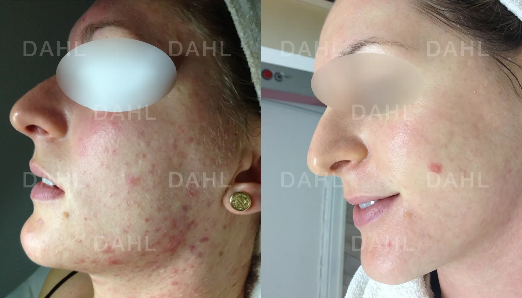 Before and after image of acne on neck