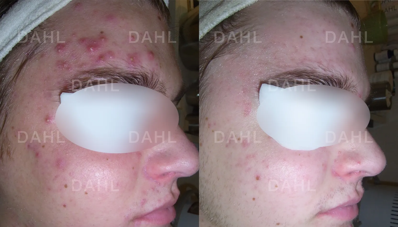 Before and after image of pustules on forehead