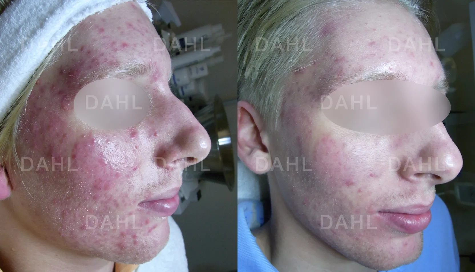 Before and after image of acne rash