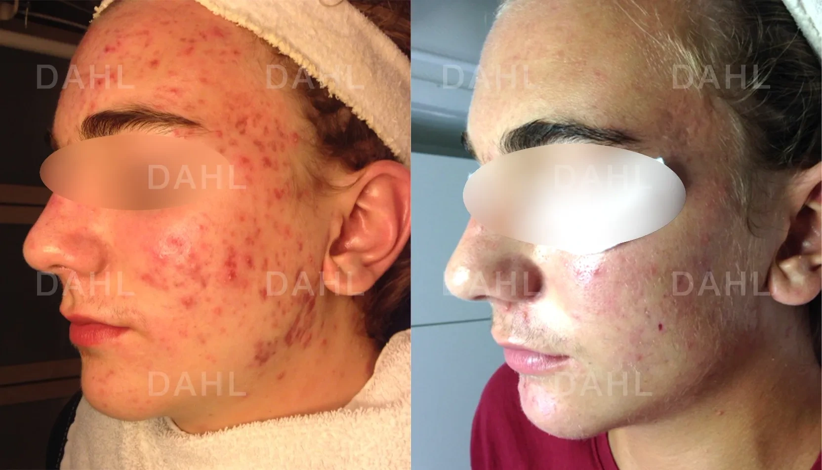 Before and after image of red marks from acne