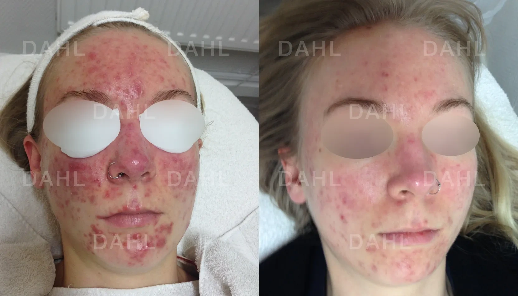 Dramatic improvement of severe acne