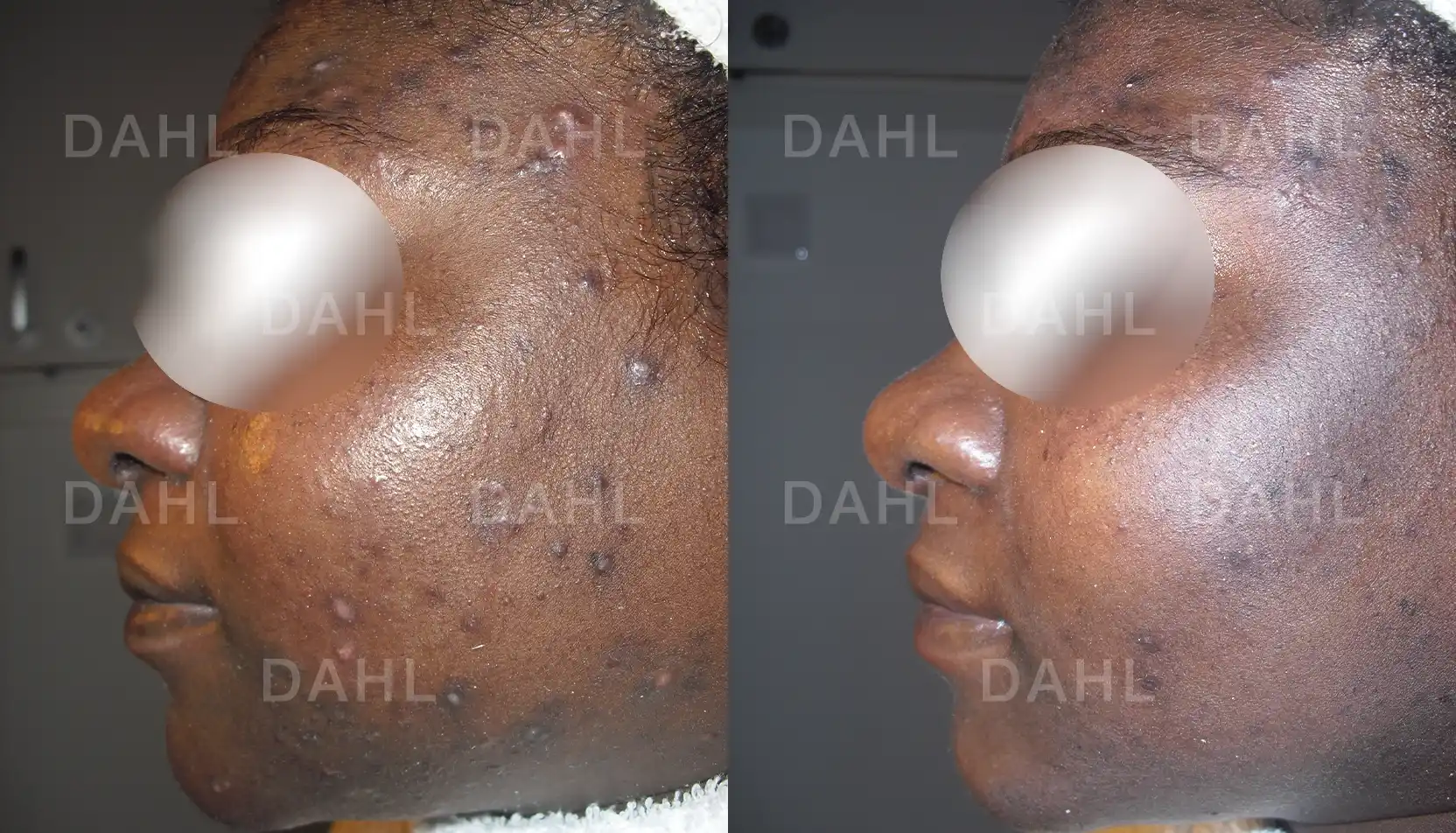 Before and after image of acne from side