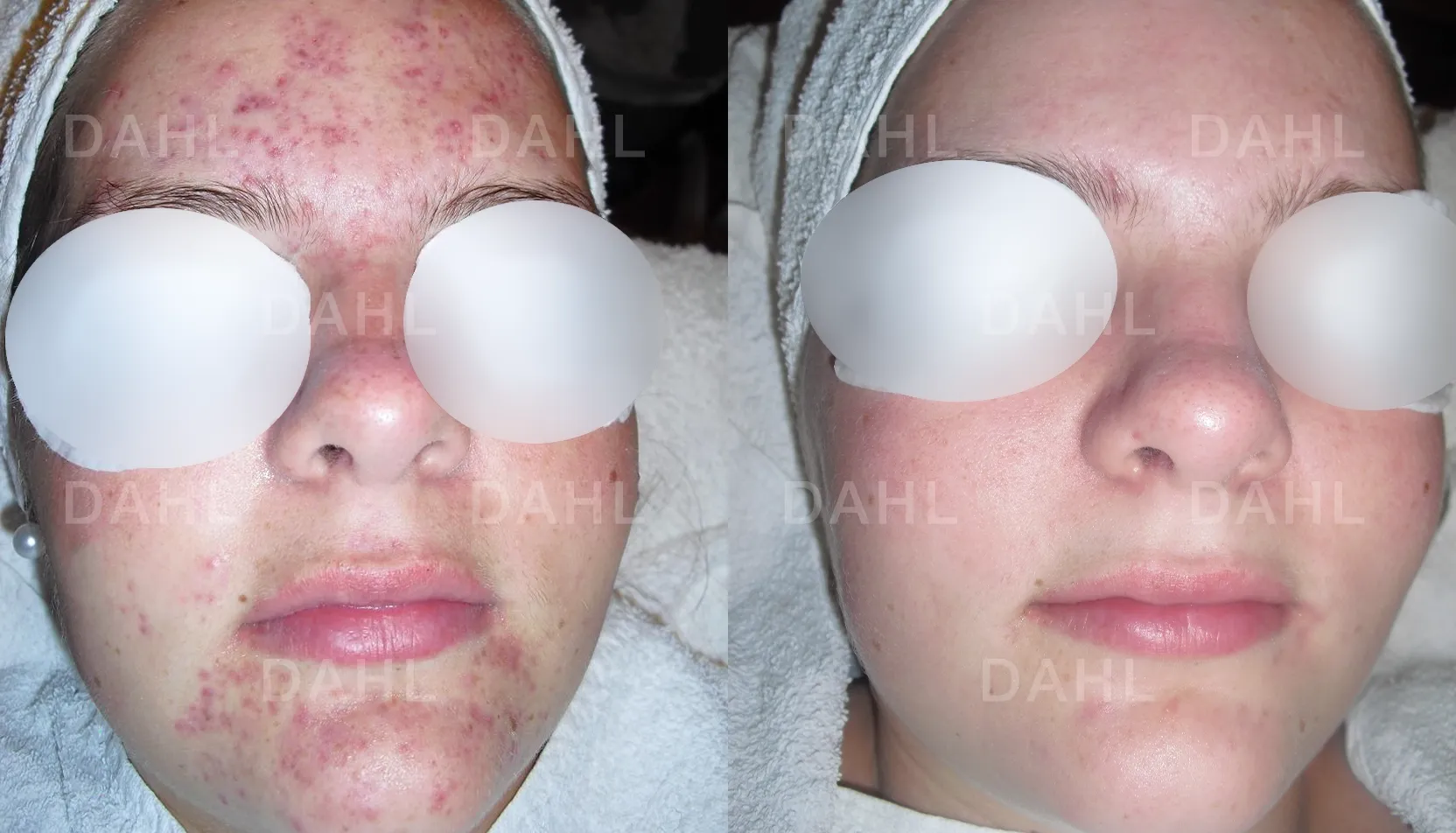 Before and after image of spots from acne