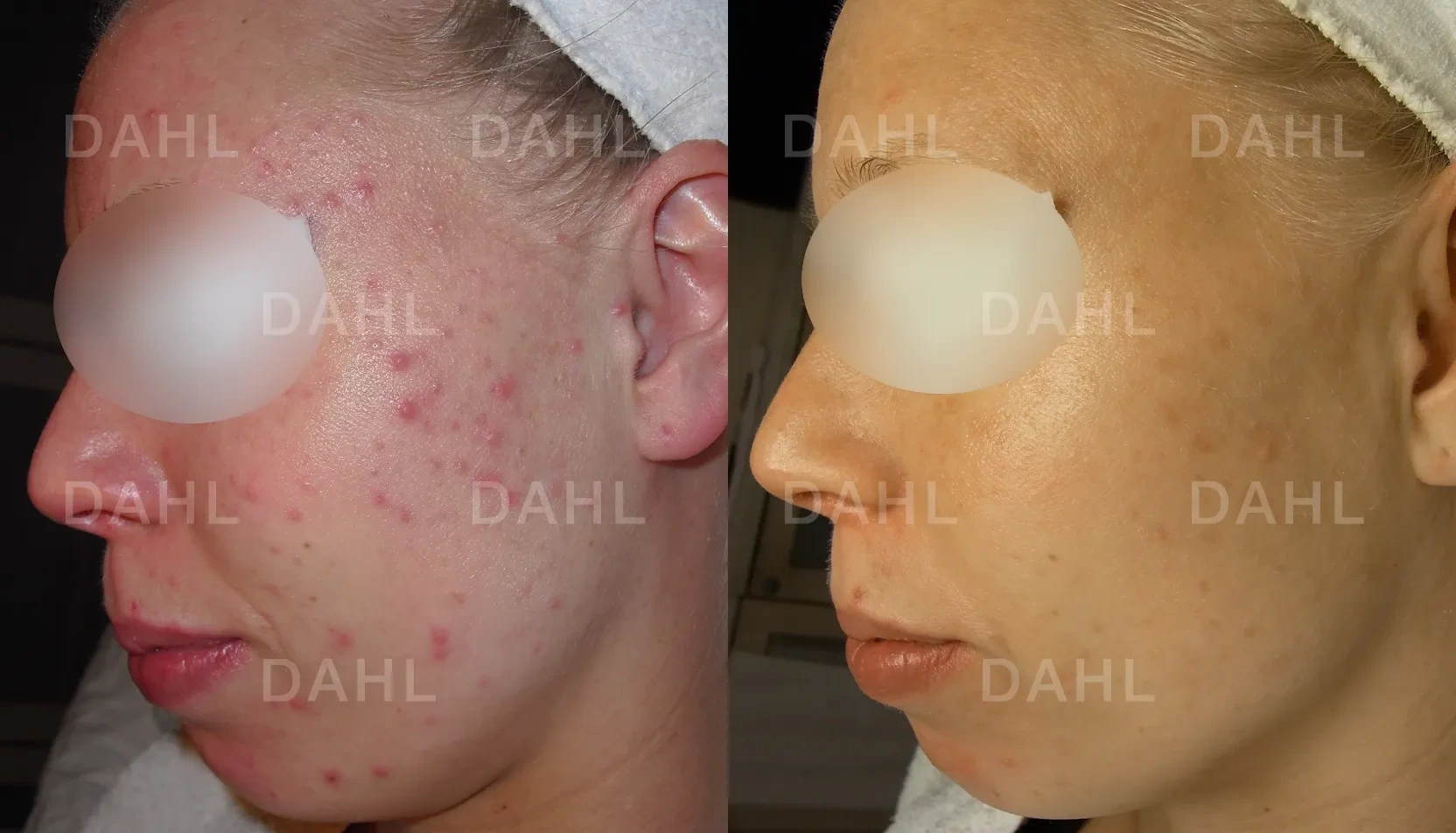 Combination skin before and after - overall results