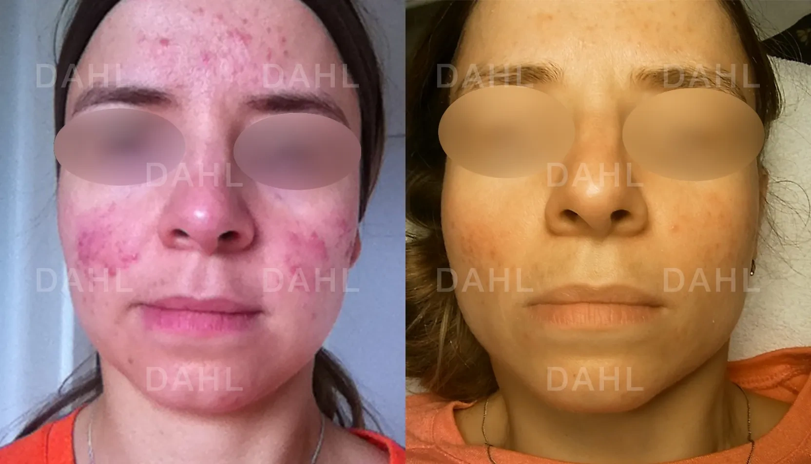 Before and after photo of rosacea treatment on cheeks