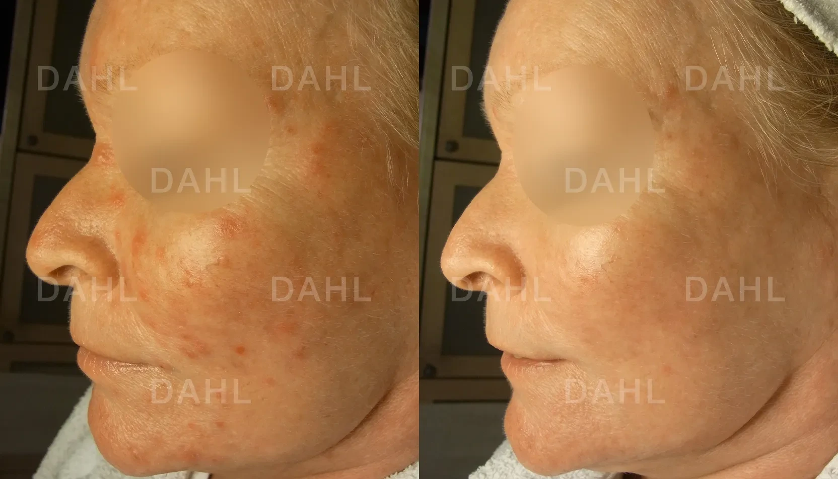 Before and after image of dots from rosacea