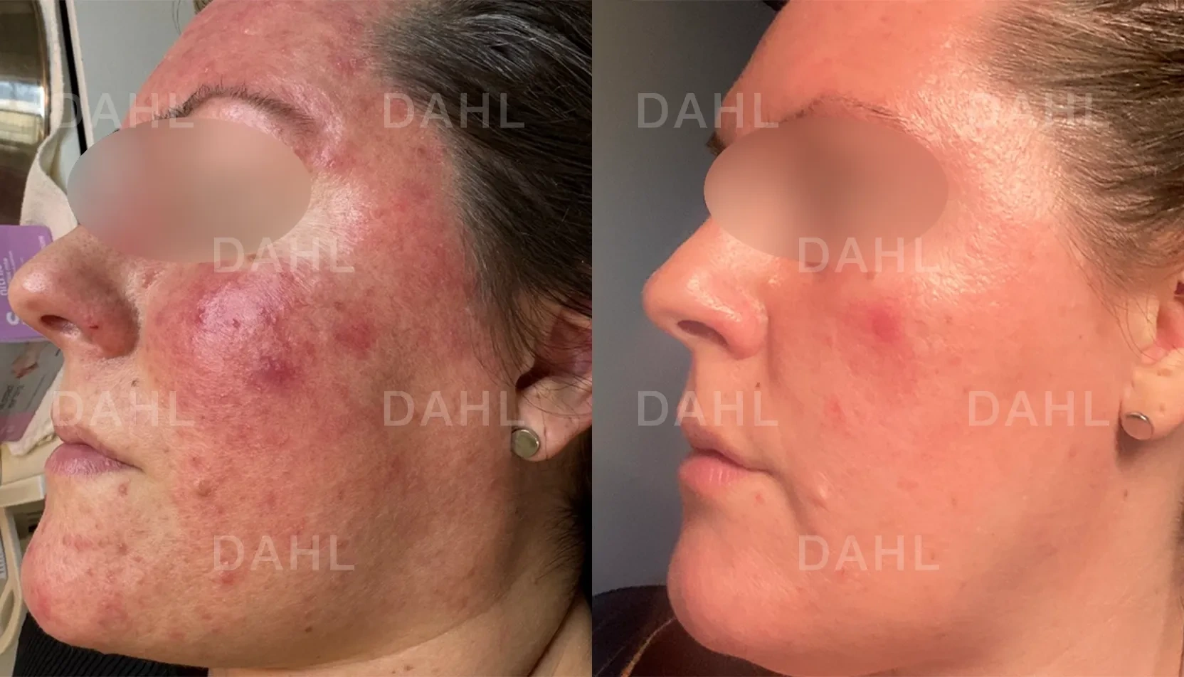 Rosacea left cheek - treatment results