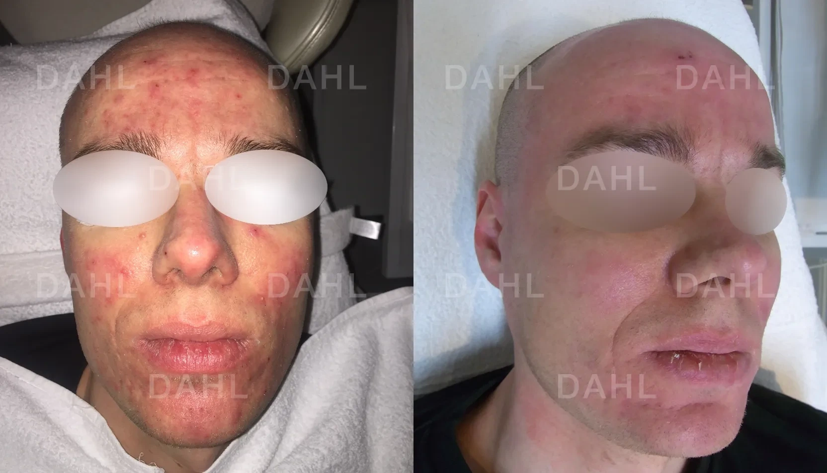Before and after image of rash on face from rosacea