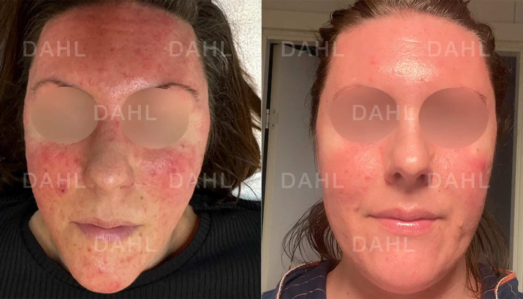Complete skin transformation with rosacea