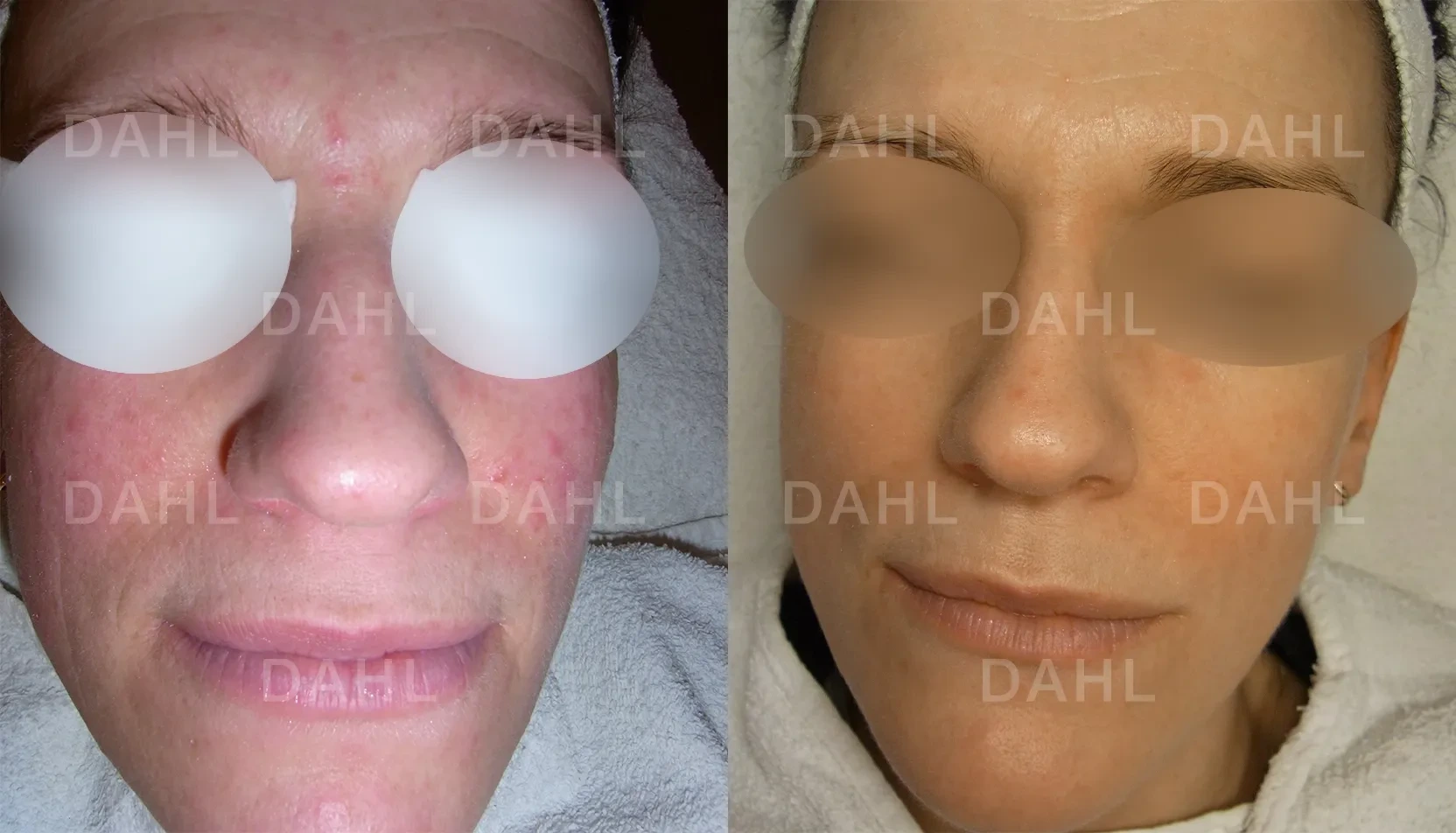 Before and after image of rosacea forehead and cheeks