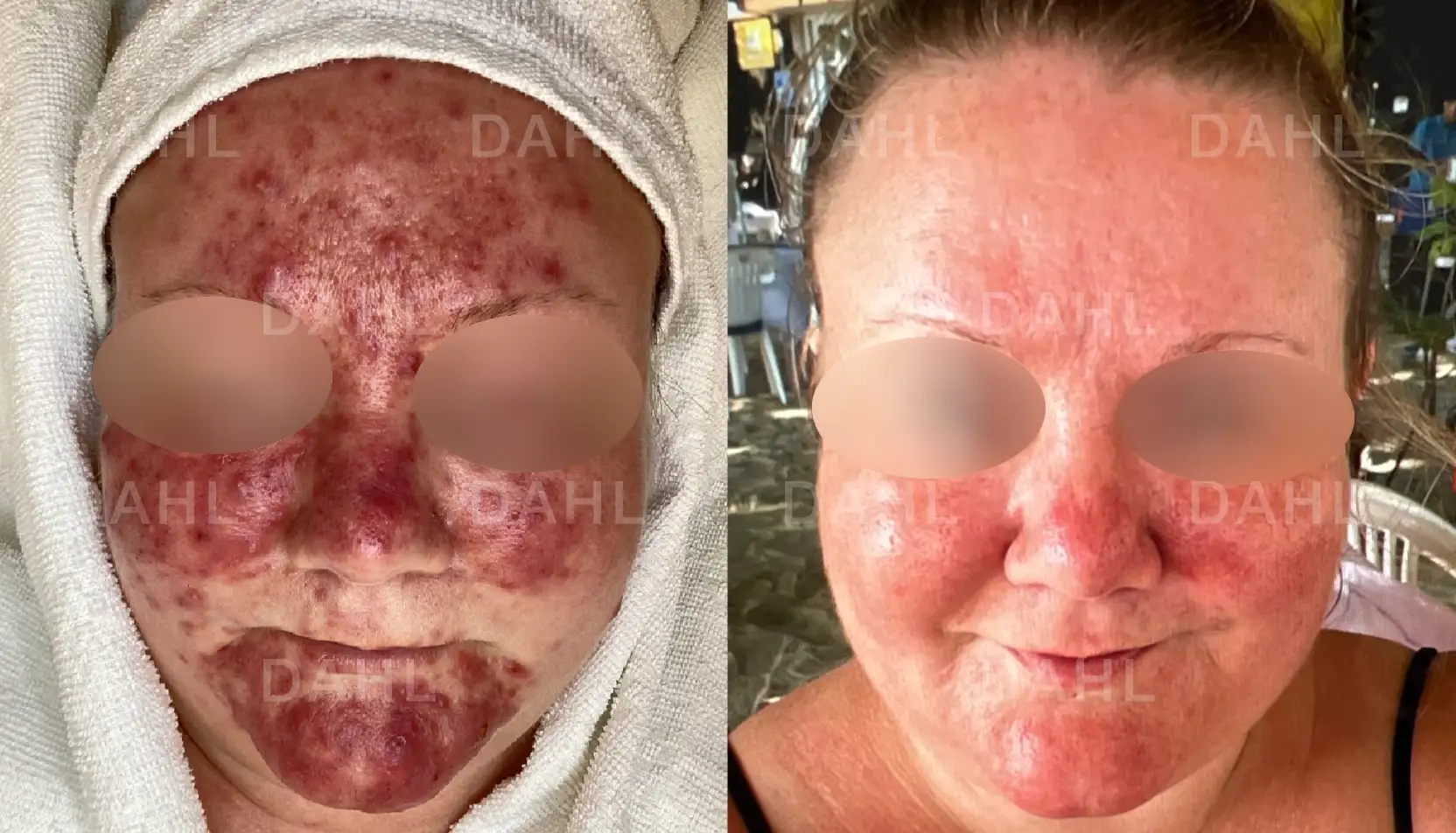 Rosacea overall results - before and after DAHL Skincare