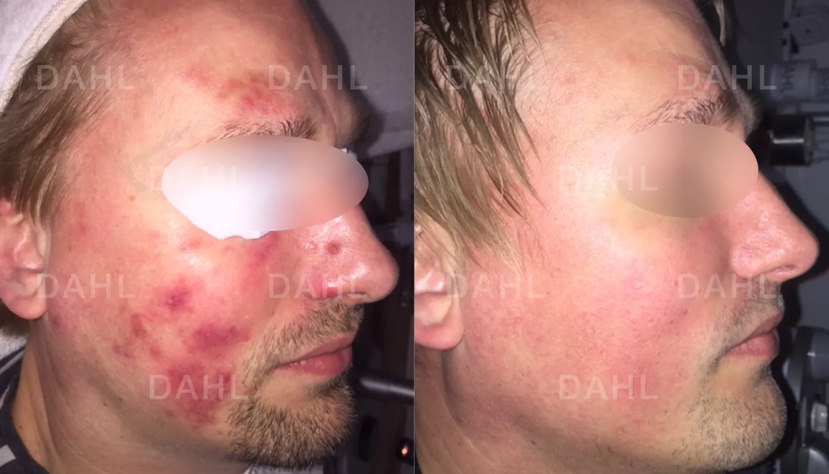 Before and after extensive rosacea