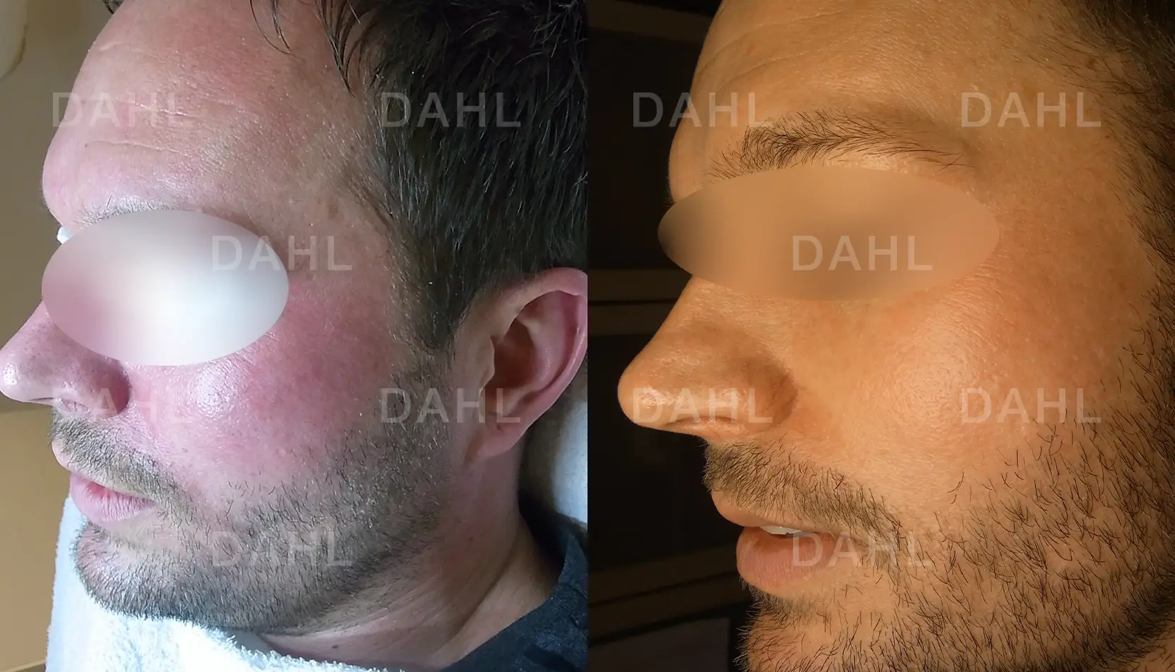 Before and after image of rosacea on nose and cheeks