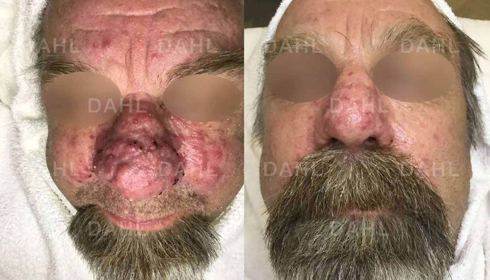 Before and after photo of rosacea on nose