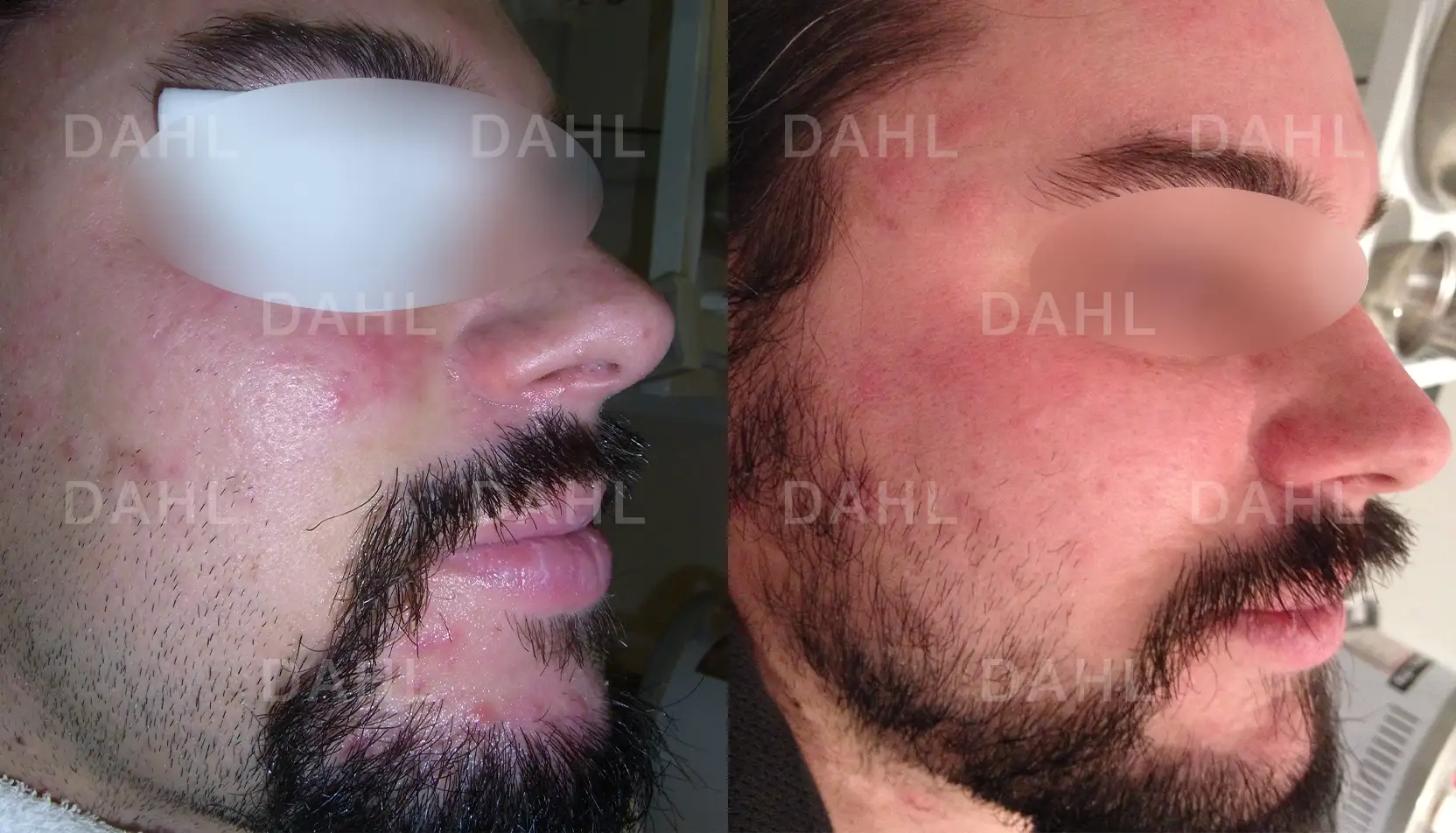 Before and after image of rash from rosacea