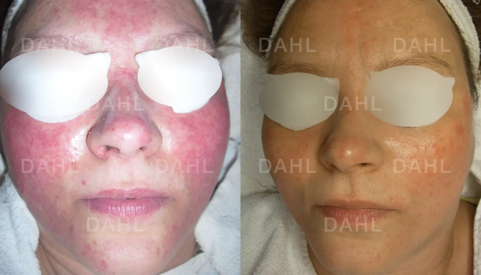 Severe rosacea before and after treatment