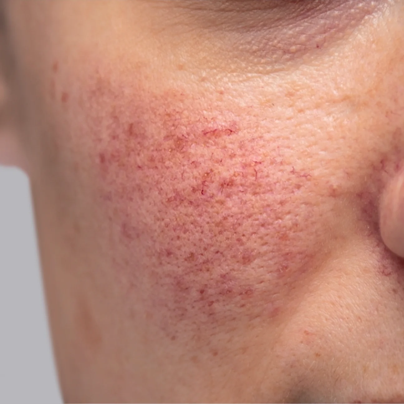 Rosacea