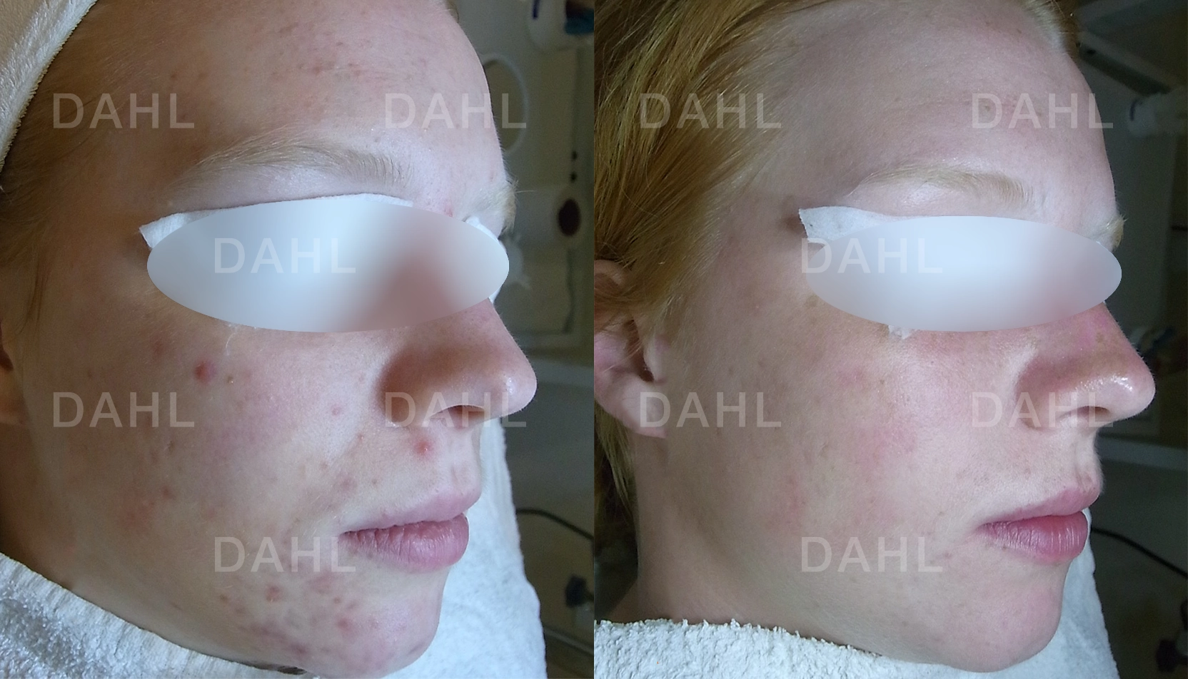 Lätt akne höger sida resultat Före- och efterbild av lätt akne på höger sida av ansiktet