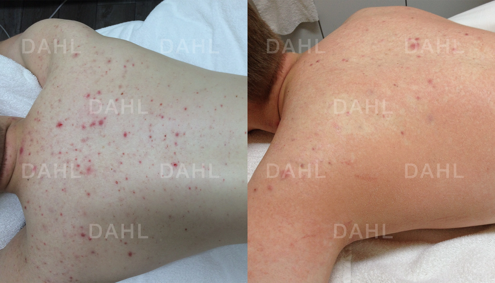 Förbättrad ryggakne Ryggakne före och efter behandling - DAHL Skincare