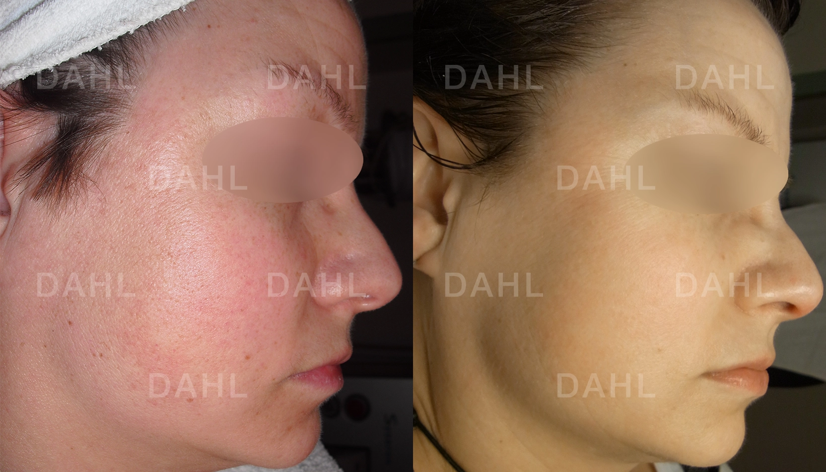 Blandhy jämnare hudton resultat Före- och efterbild av blandhy med jämnare hudton