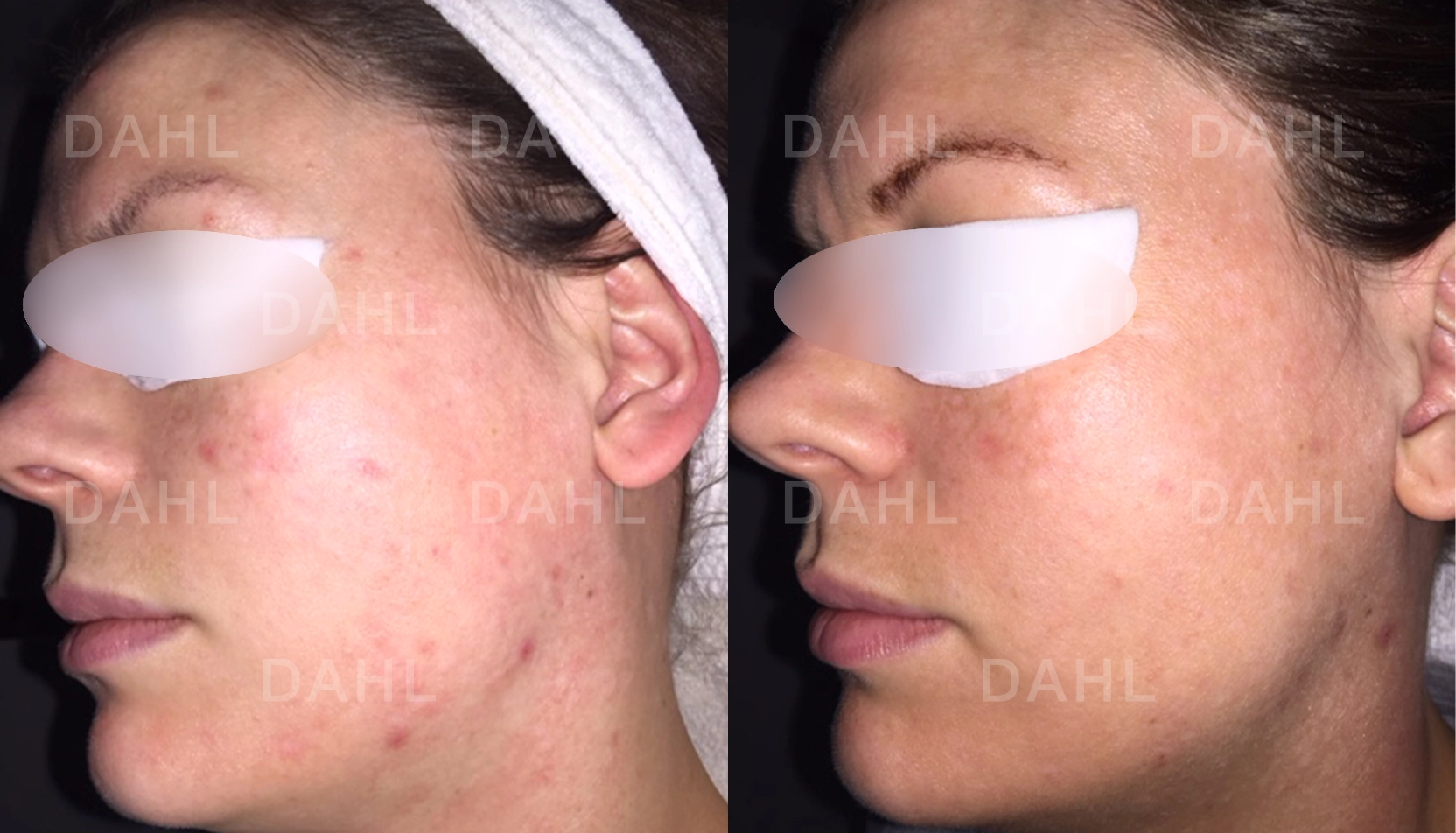 Blandhy vänster sida resultat Före- och efterbild av blandhy på vänster sida av ansiktet